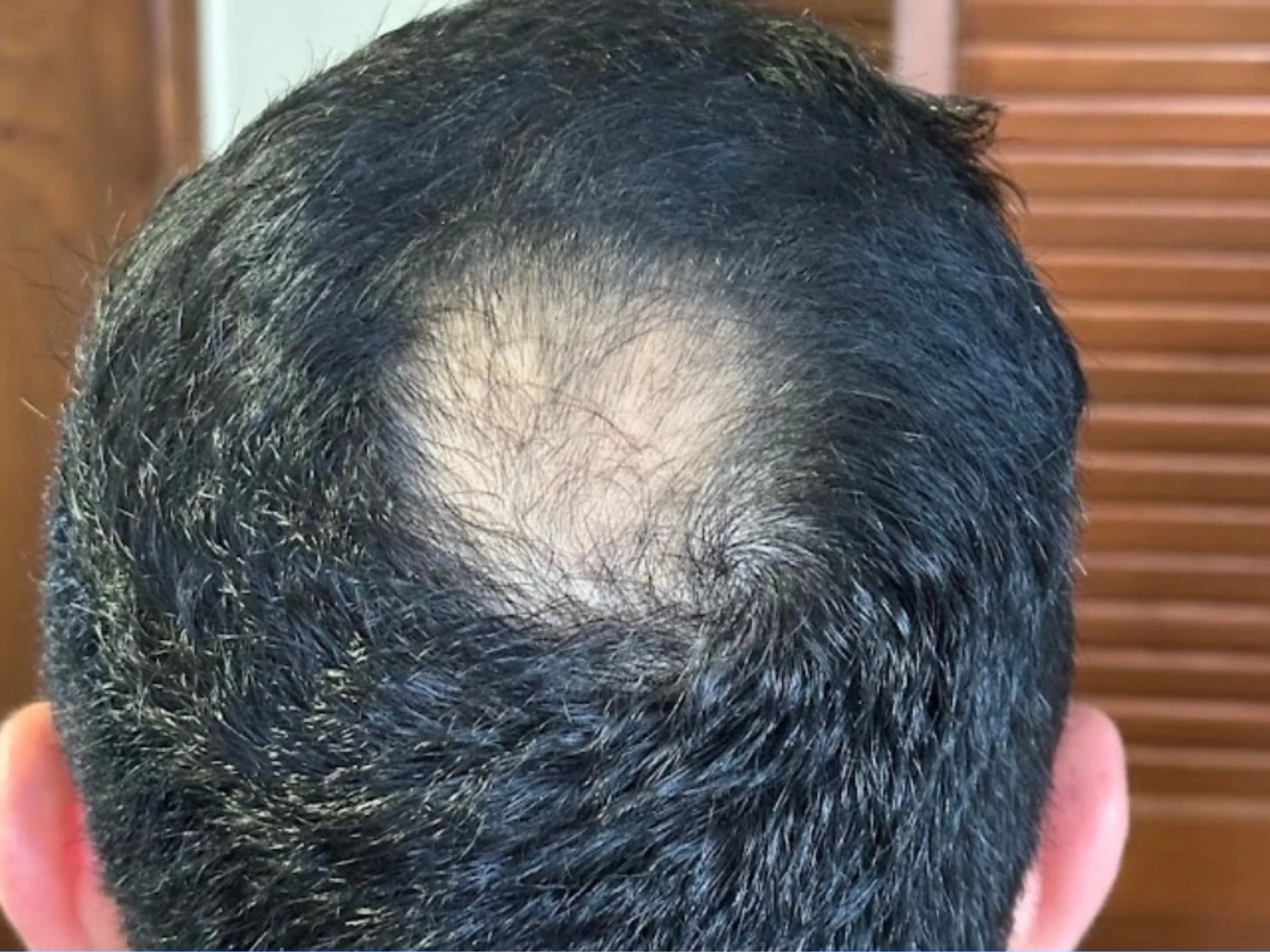 Antes tratamiento alopecia