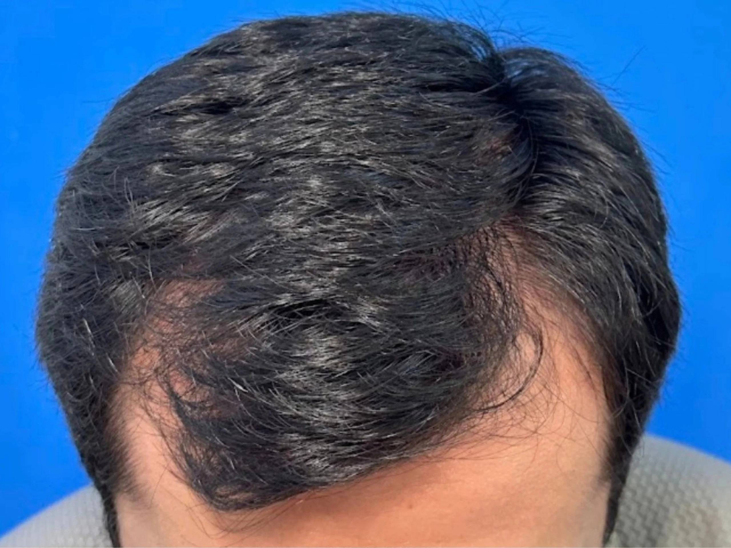 Antes