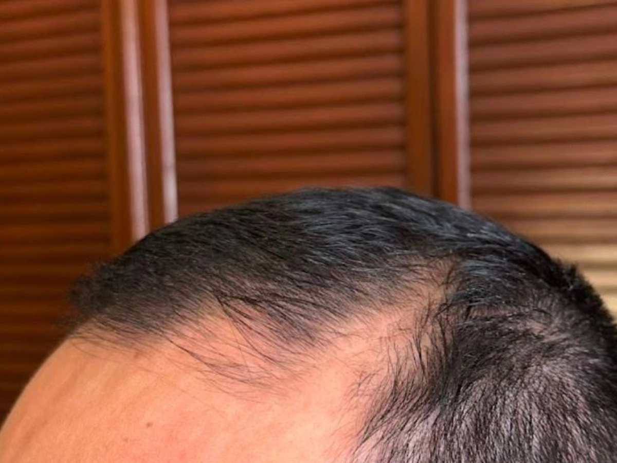 Antes