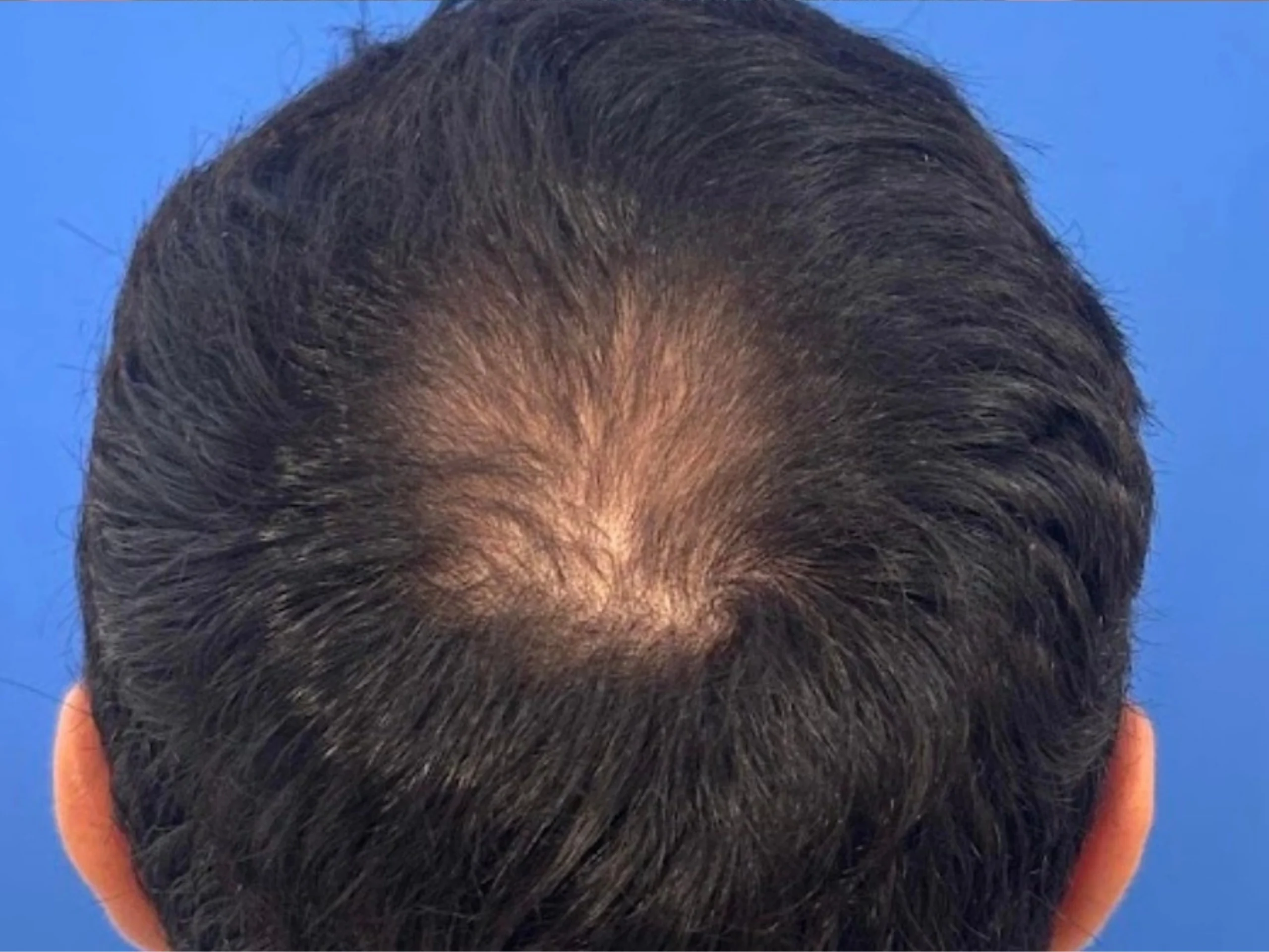 Después tratamiento alopecia