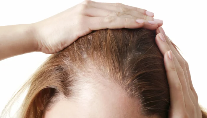 Caida de cabello